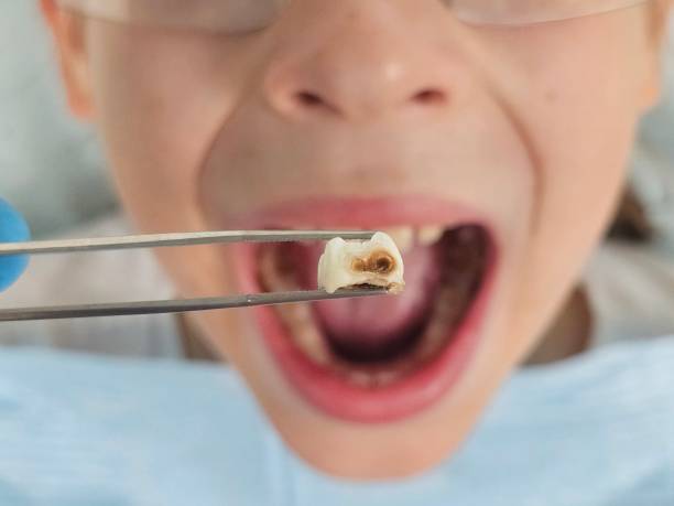 Best Broken or Chipped Tooth Repair in Highland City, FL